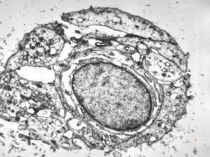 F, 62y. | myxoma atrii F, 62y. | myxoma atrii